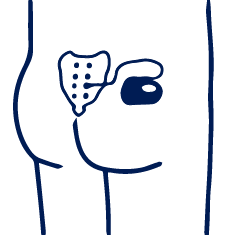 Sacral Nerve Stimulation